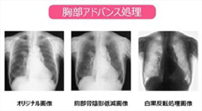 胸部レントゲン検査02